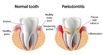 diagram of healthy gums and infected gums 