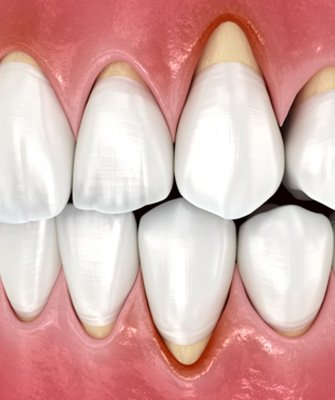 diagram of receding gums 