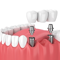 diagram of an implant bridge