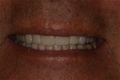 Case 13 after treatment